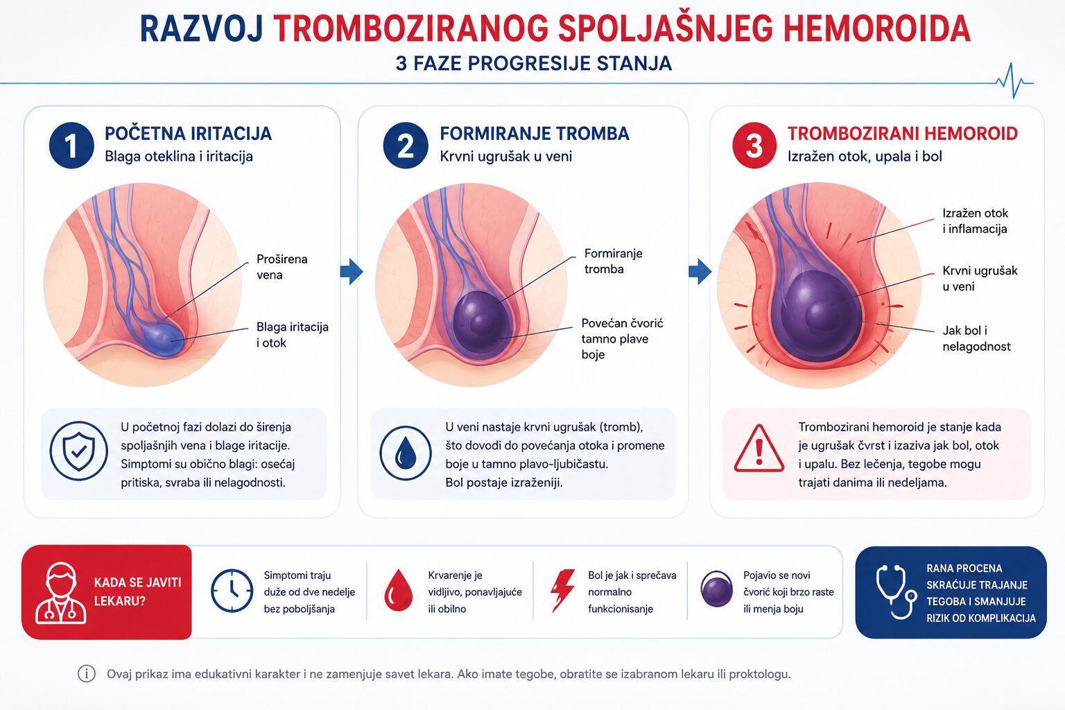 Kod tromboziranog hemoroida najvažnije je ne čekati predugo, jer pregled u prvih 48 do 72 sata može značajno promeniti tok lečenja i omogućiti brže olakšanje kod jakog bola.